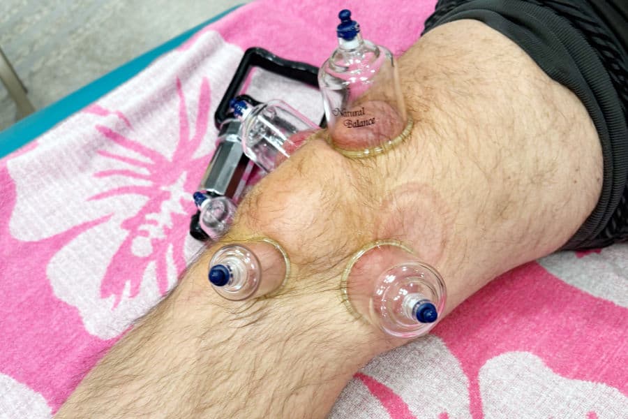 Cupping tehnika Higeja 7 (1)